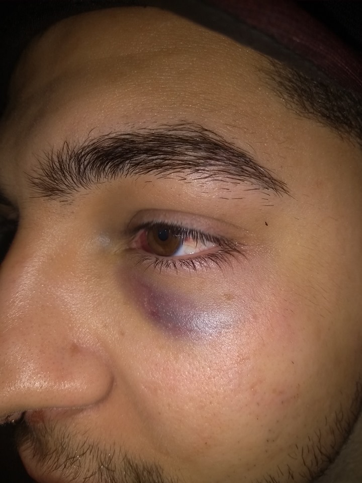 Jovem fica com hematomas após agressão em casa noturna. Foto: Arquivo Pessoal