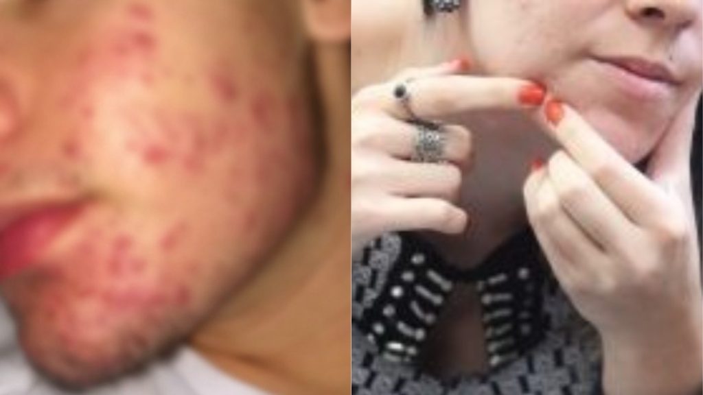 Jovens com acne