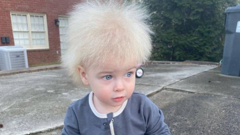 criança síndrome cabelo
