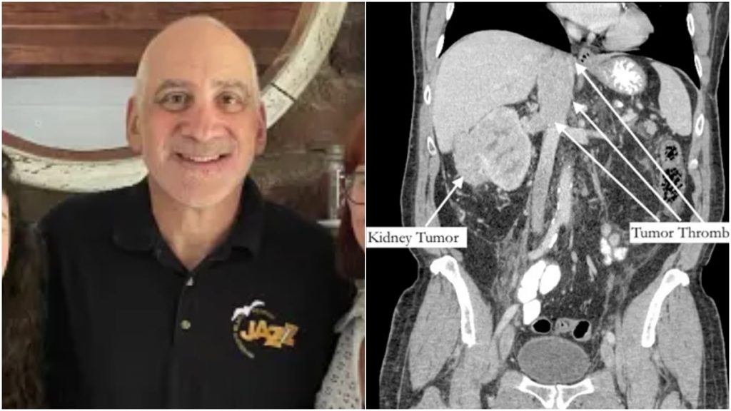 tumor