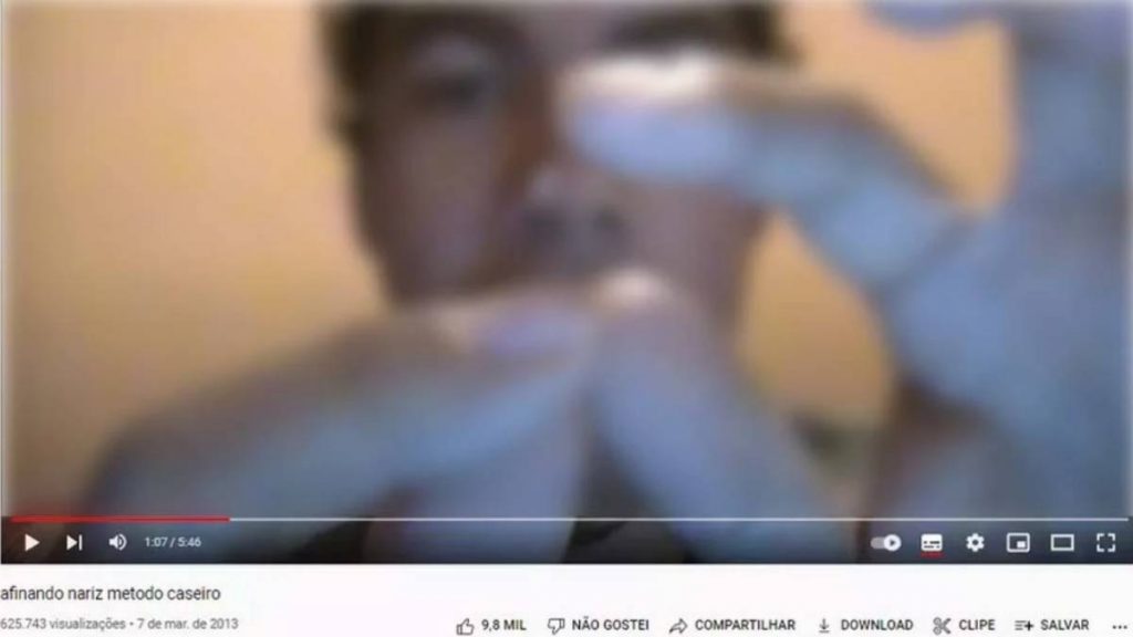 rinoplastia caseira youtube