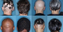 pacientes em tratamento contra a alopecia