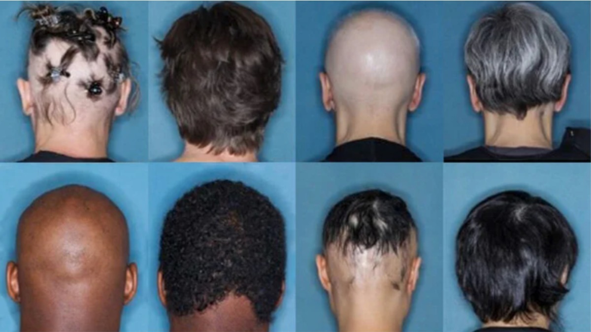 pacientes em tratamento contra a alopecia