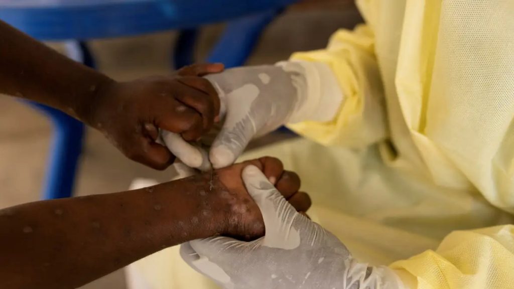 Lagoa Santa, na Grande BH, monitora caso suspeito de Mpox