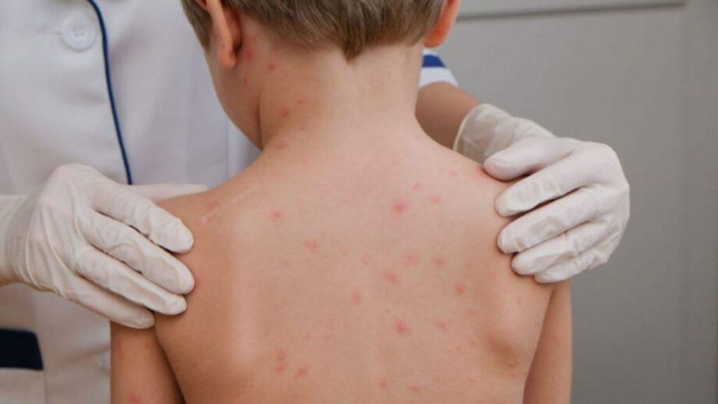 betim meningite bacteriana