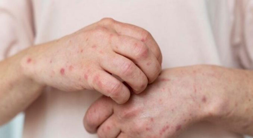 A cidade de Andradas, no Sul de Minas, confirmou 11 casos de sarna humana em uma creche