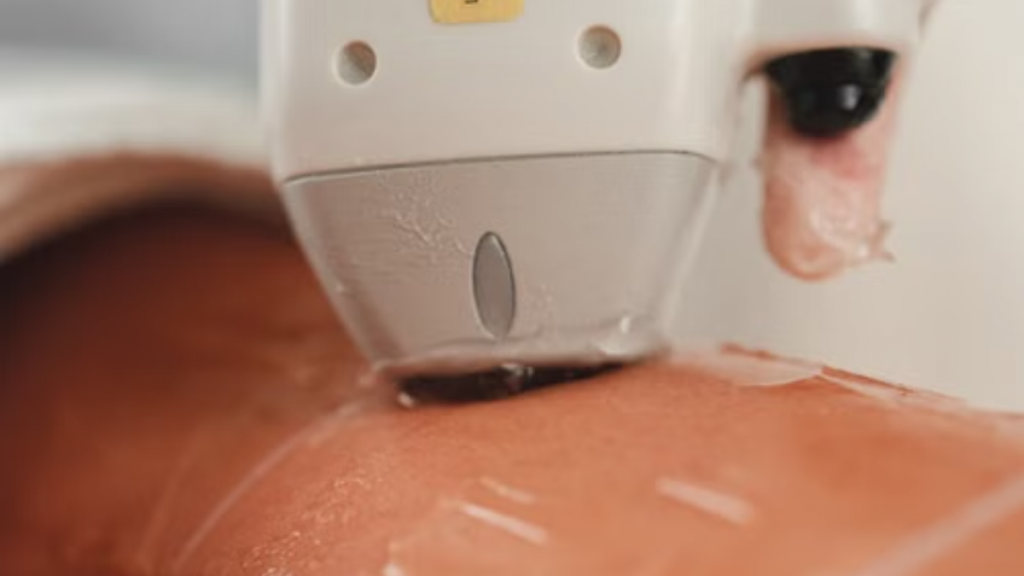 Mulher que sofreu com queimadura de 3º após aplicação de laser é indenizada por danos estéticos